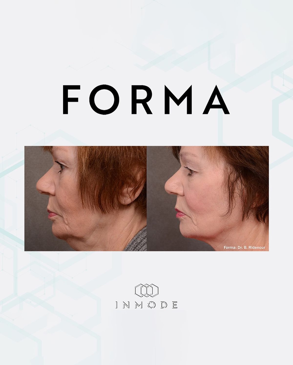 Forma-RF Treatment